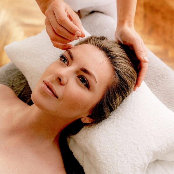 acupuntura estética facial notox en spa